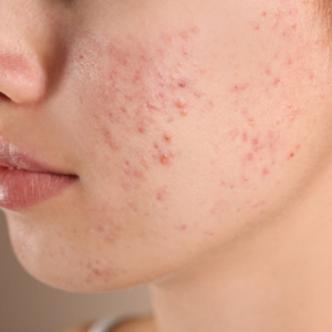 Acne/Oil Control