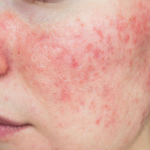 Redness/ Rashes Solution